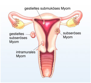 Die Abbiödung zeigt eien Gebärmutter, wo auf der rechten und linken Seite Myome zu erkennen sind. Außerdem wird die ANatomie der Gebärmutter beschrieben.